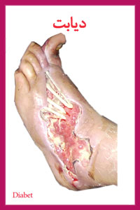 دیابت و معجزه آب یونیزه قلیایی