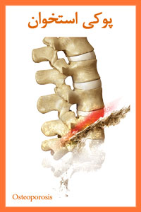 پوکی استخوان و معجزه آب یونیزه قلیایی